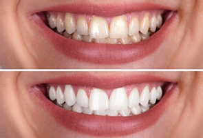 before and after teeth whitening in Wharton