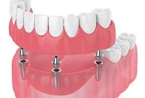 Diagram of implant-retained dentures in Wharton