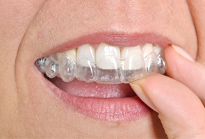 mouth Invisalign