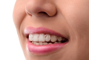 A woman with clear aligners